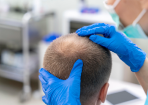 Desvendando a Alopecia Areata: Causas, Sintomas e Opções de Tratamento